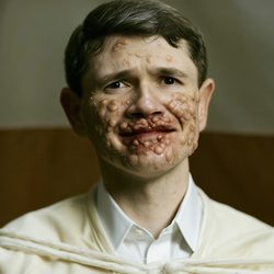 monkeypox-talarico